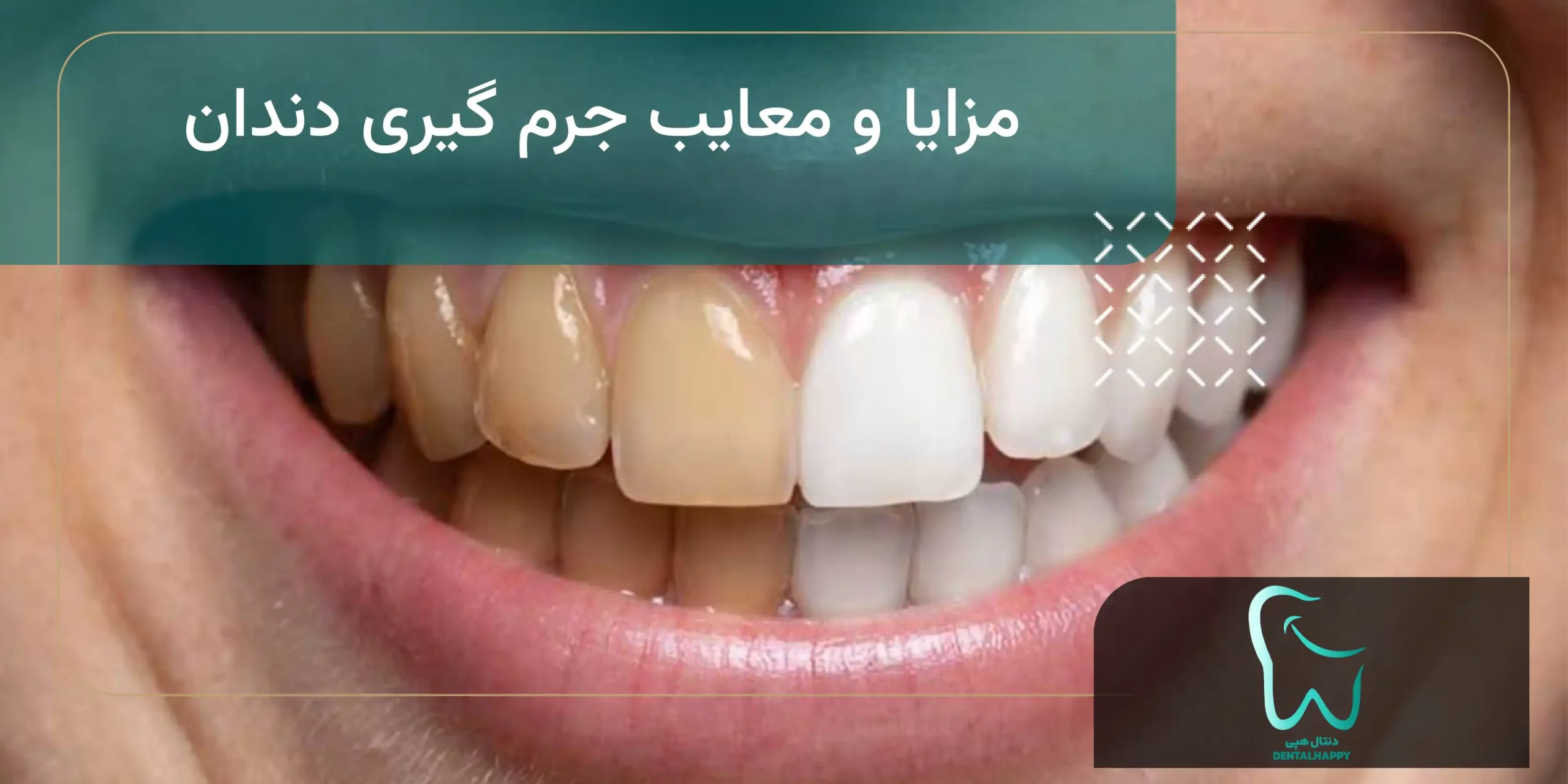 مزایا و معایب جرم گیری دندان - دنتال هپی