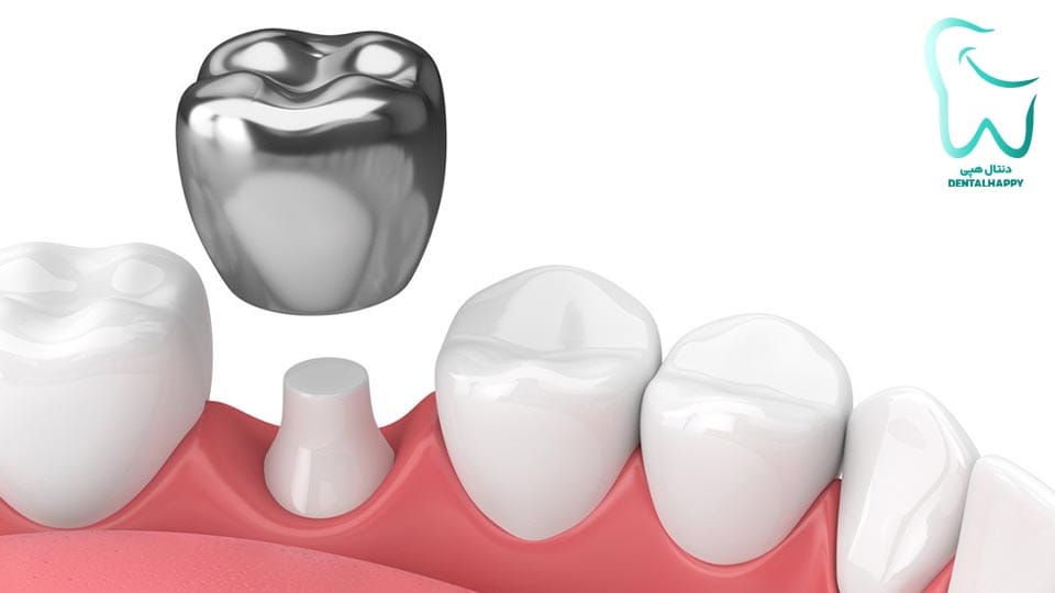 روکش استیل دندان (ضد زنگ) - دنتال هپی