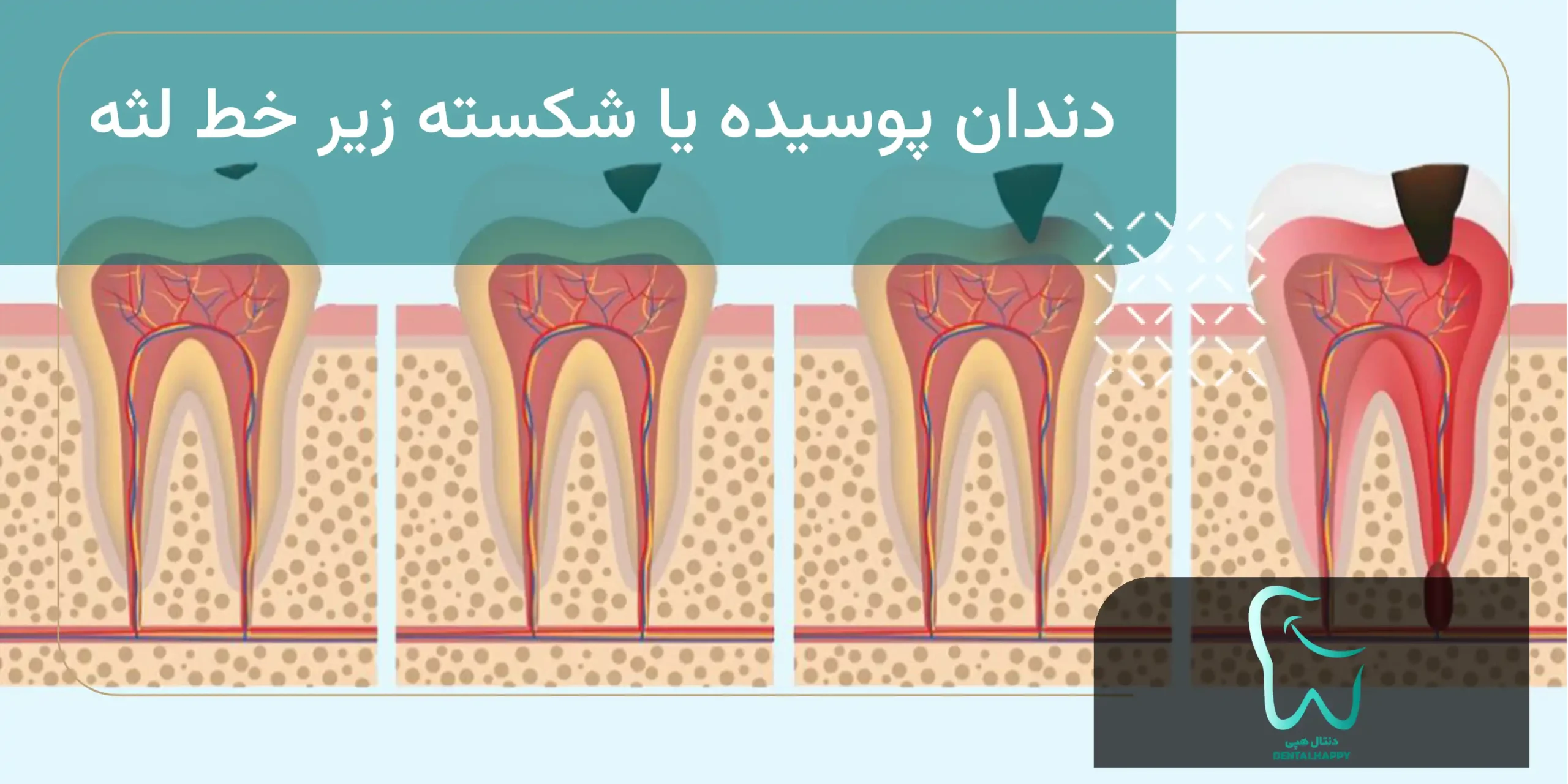 دندان پوسیده یا شکسته زیر خط لثه - دنتال هپی