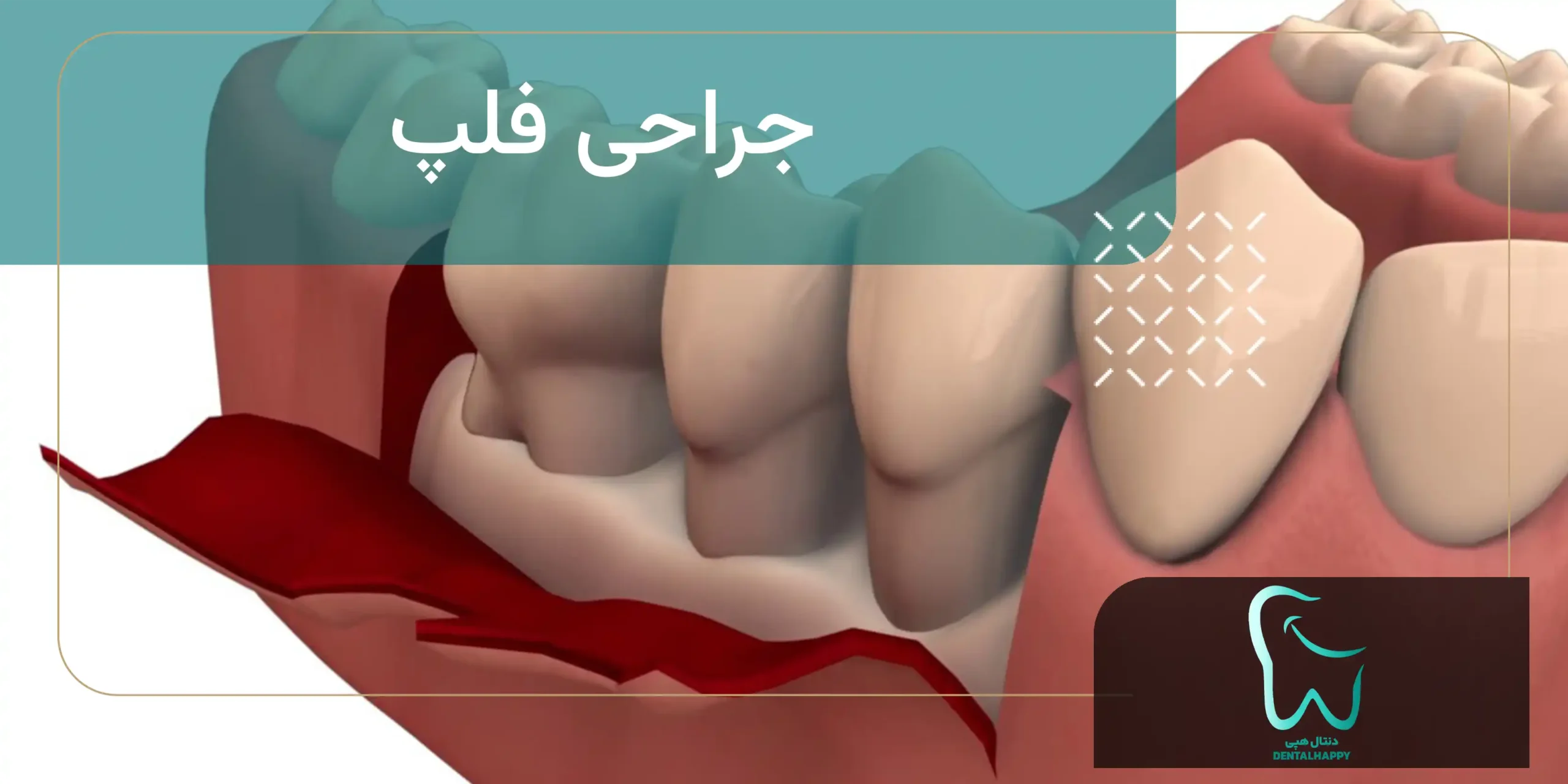 جراحی فلپ - دنتال هپی