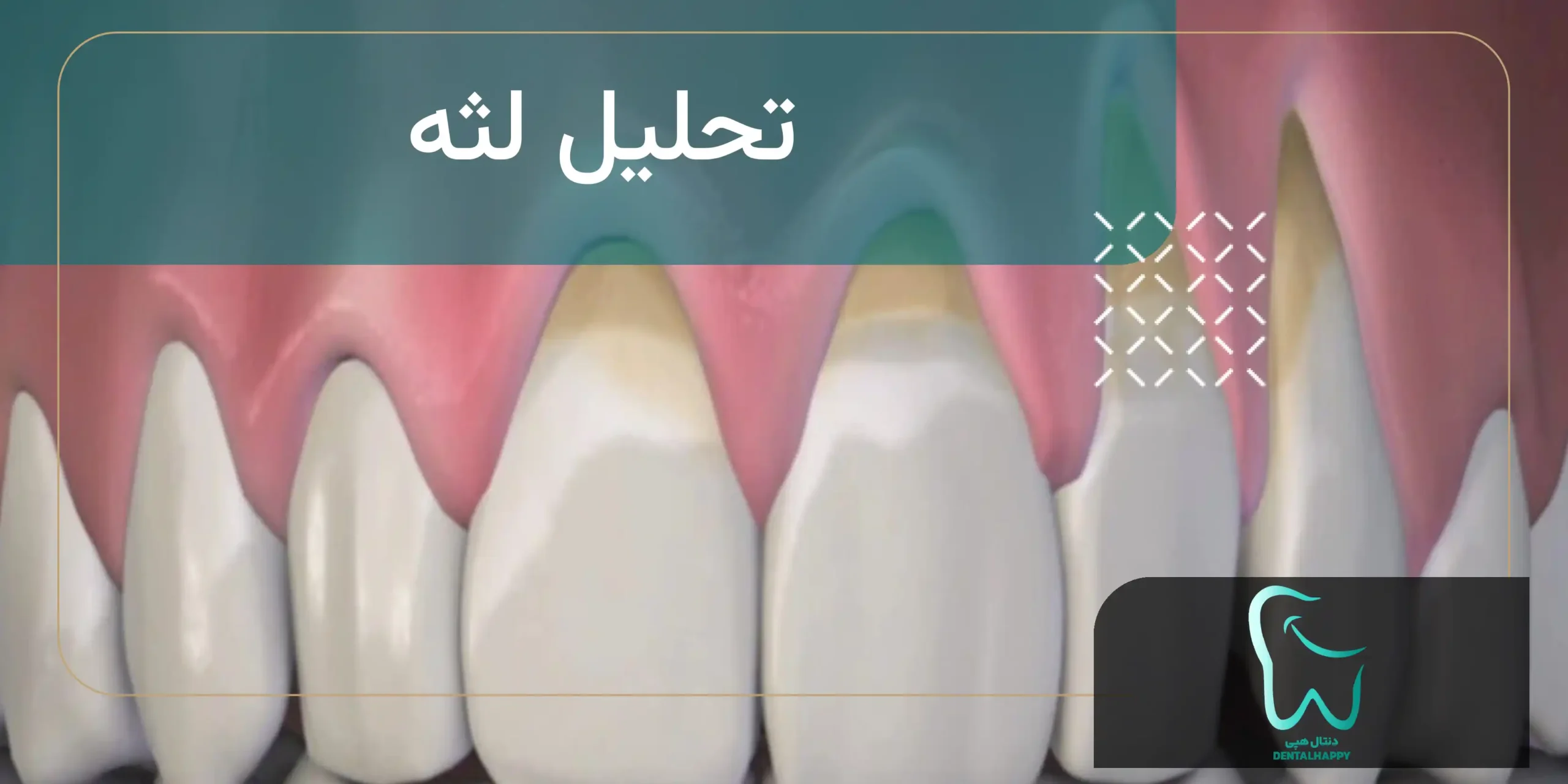 تحلیل لثه - دنتال هپی