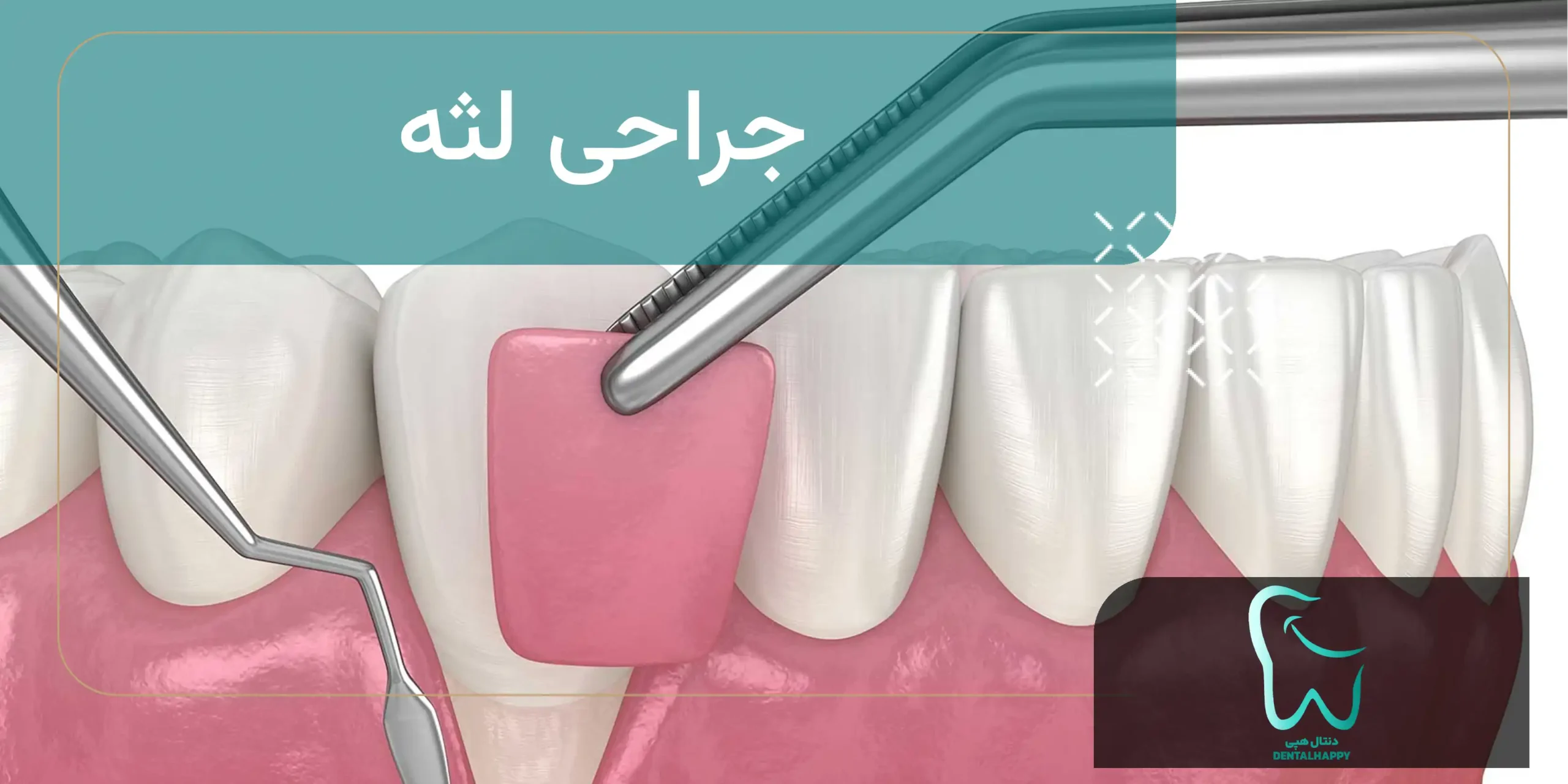 جراحی لثه - دنتال هپی