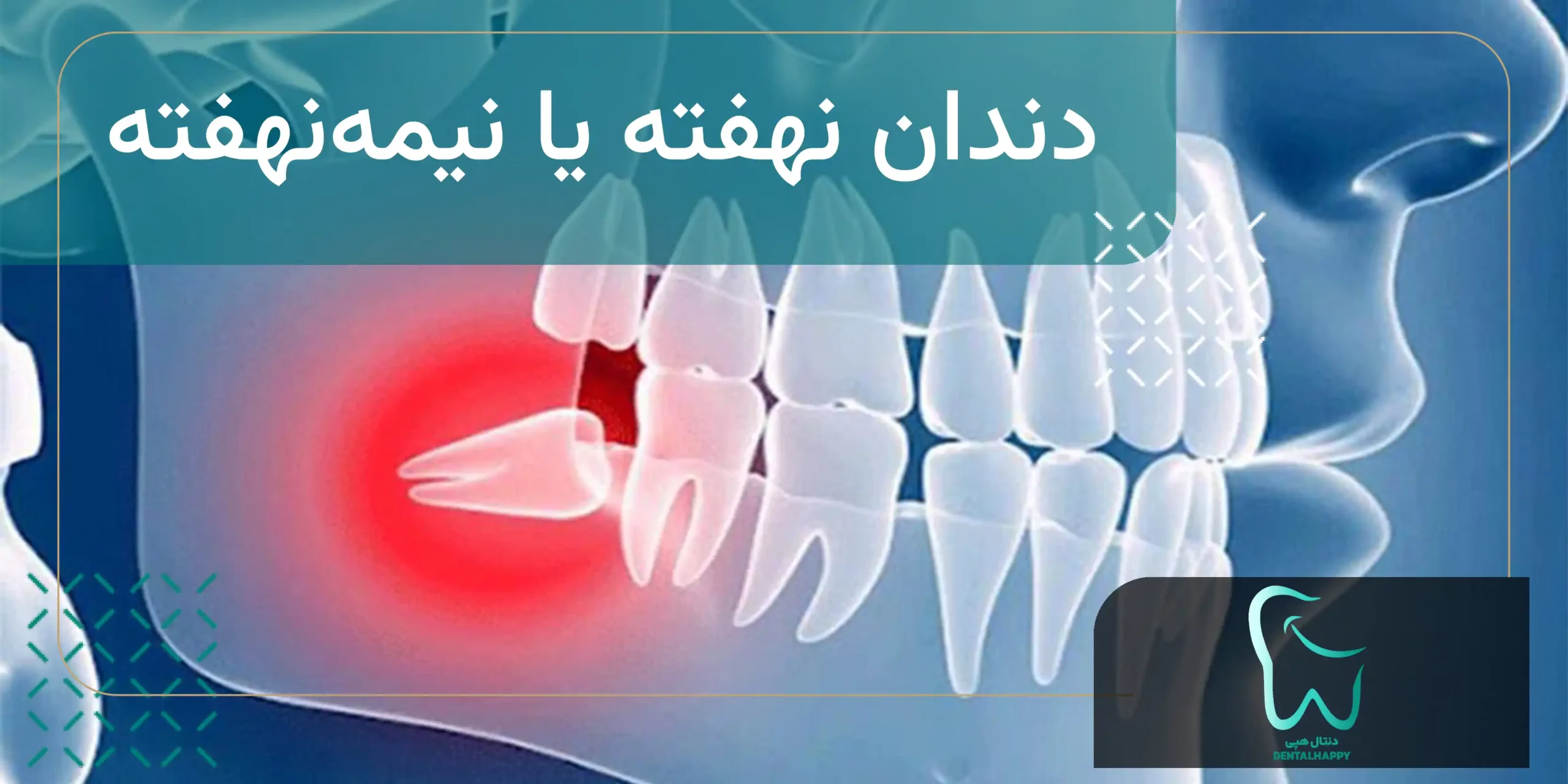 دندان نهفته یا نیمهنهفته - دنتال هپی