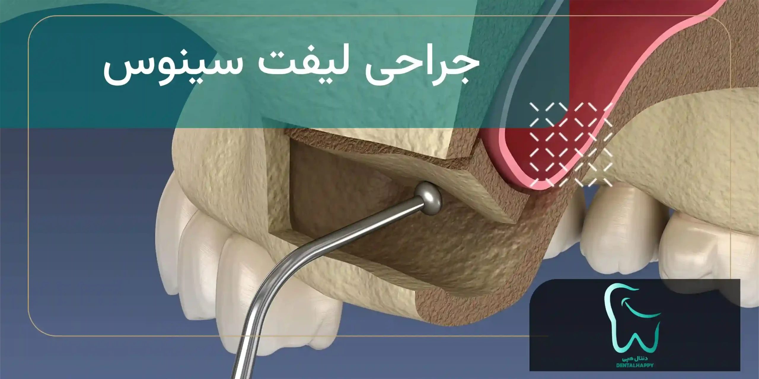 جراحی لیفت سینوس - دنتال هپی