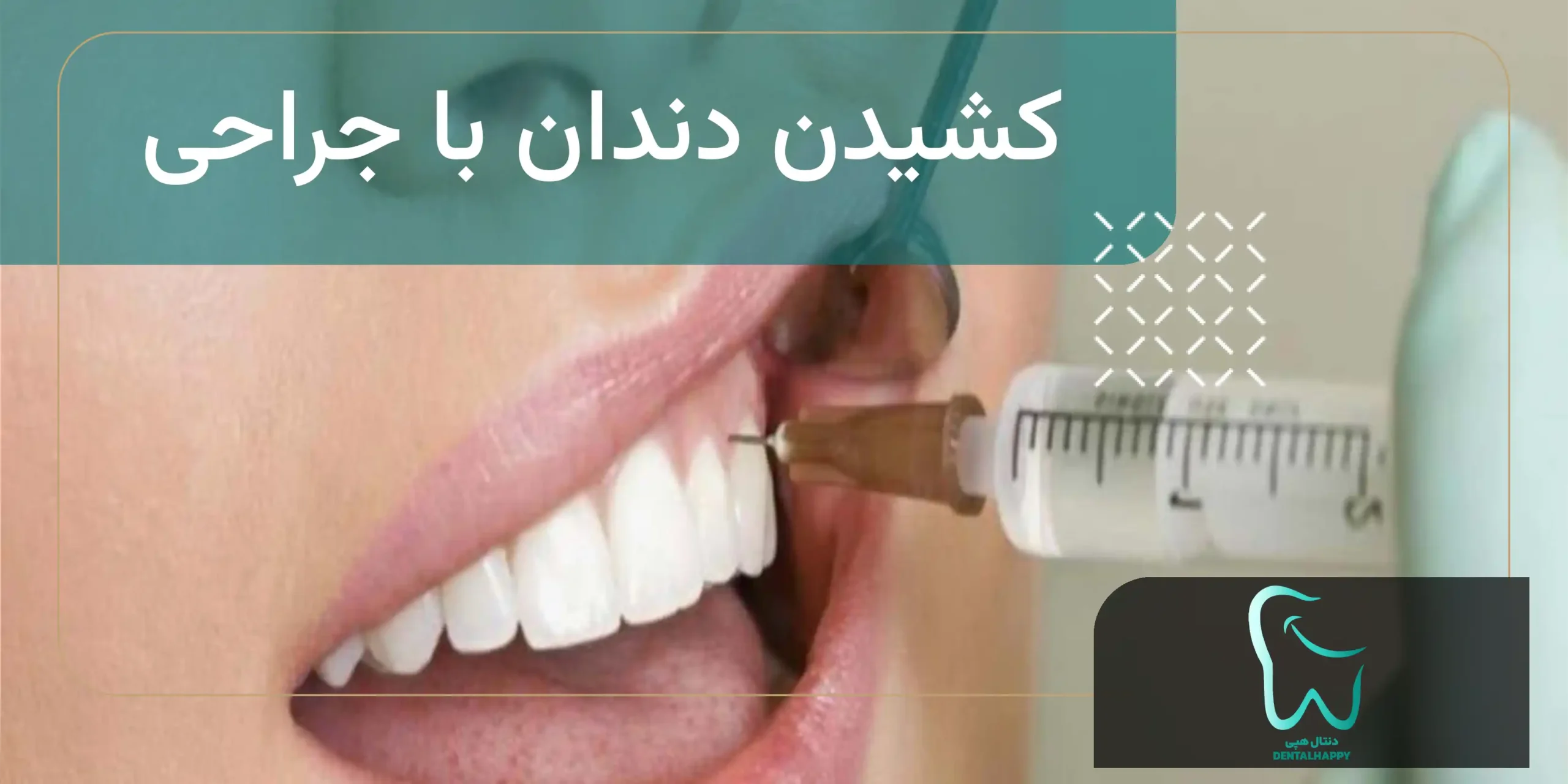 تفاوت کشیدن دندان با جراحی و بدون جراحی - دنتال هپی