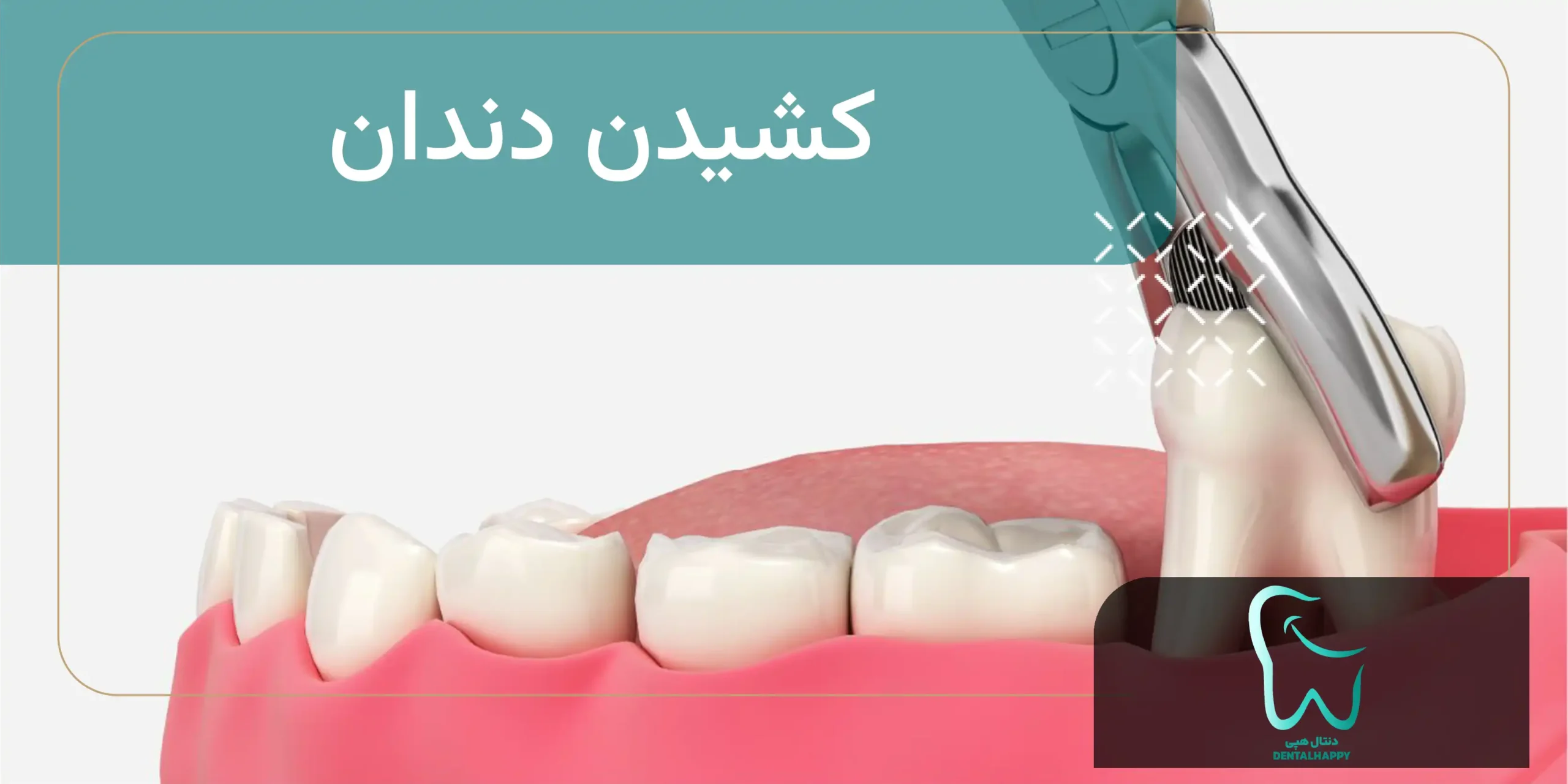 کشیدن دندان - دنتال هپی