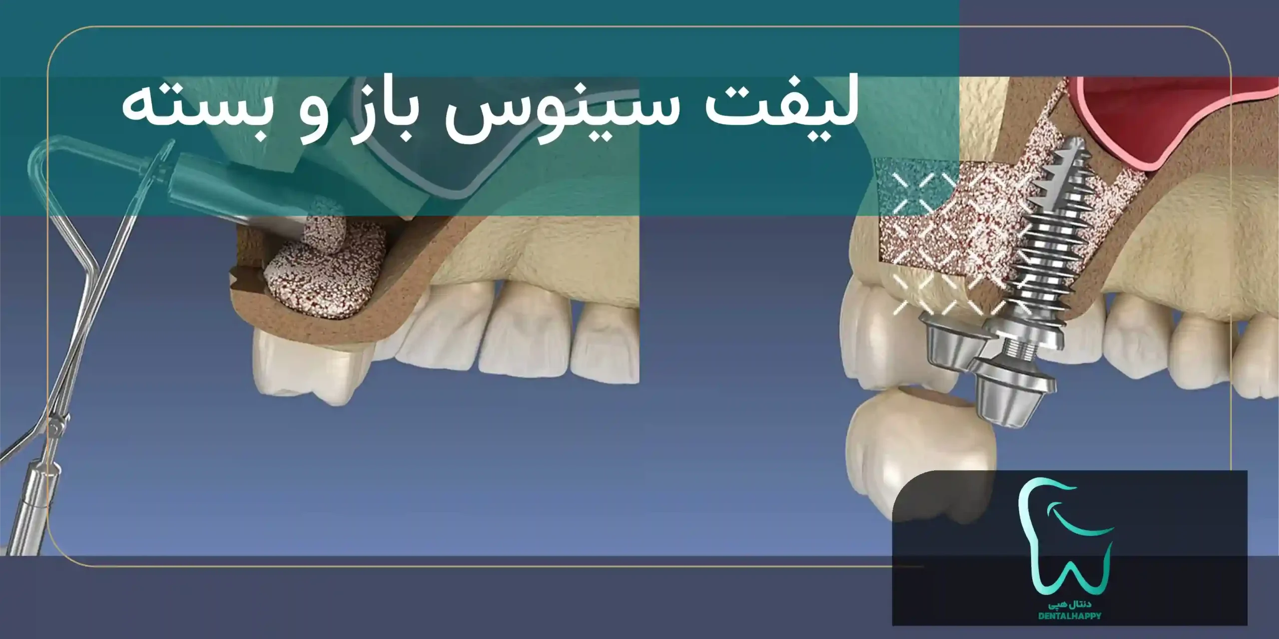 انواع جراحی لیفت سینوس - دنتال هپی