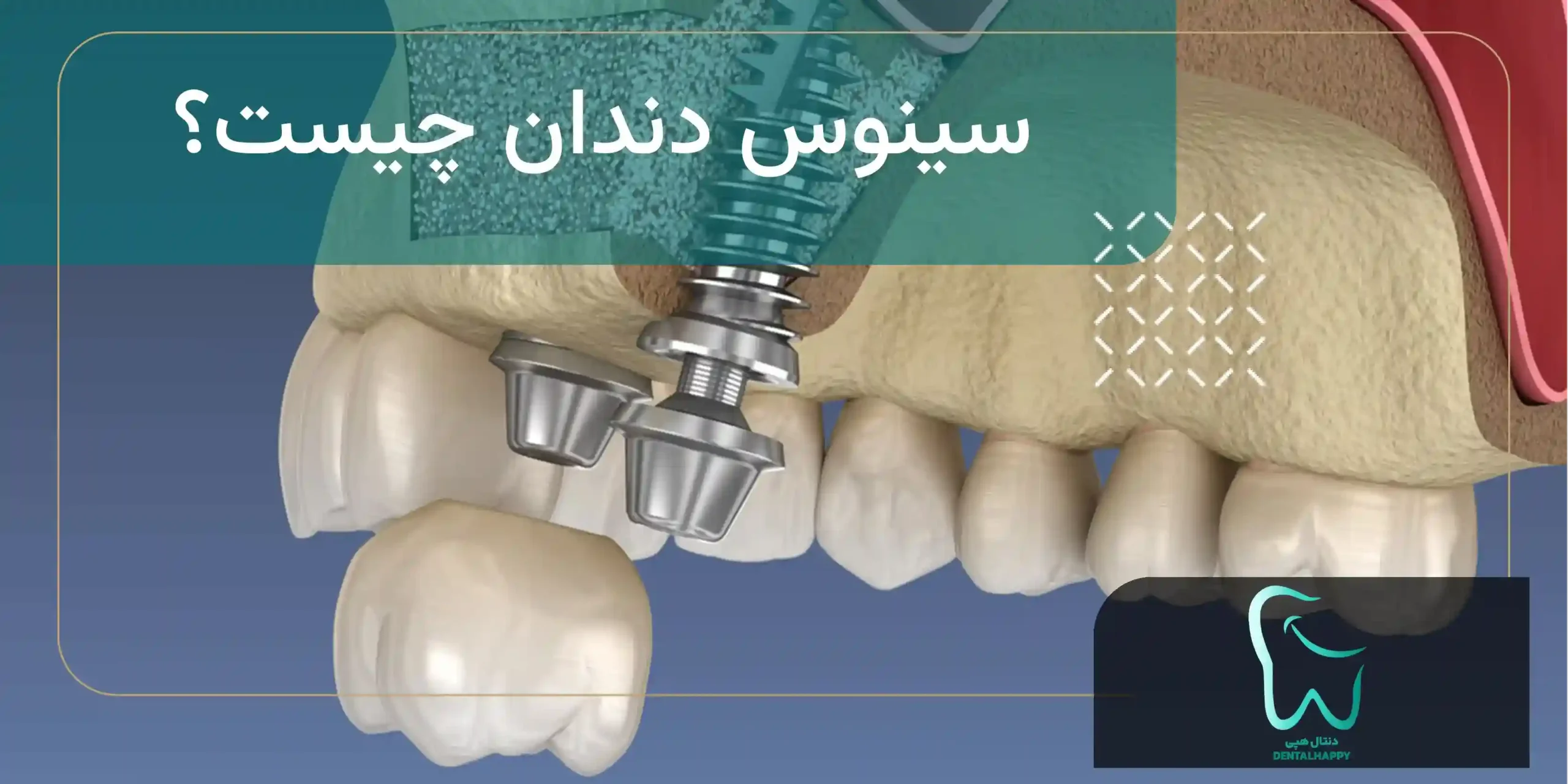 سینوس دندان چیست - دنتال هپی