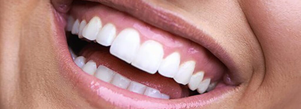 لمینت دندان خرگوشی چیست؟