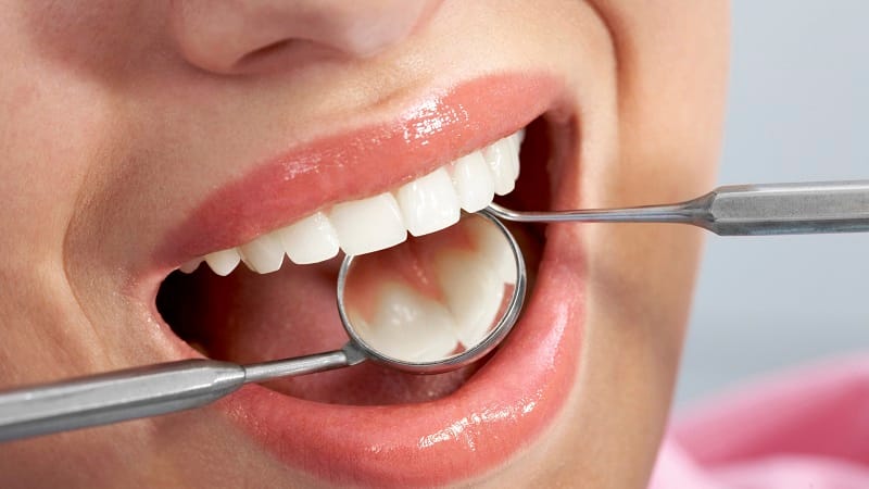نحوه انجام لمینت دندان خرگوشی