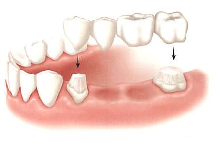 قیمت روکش دندان PFM
