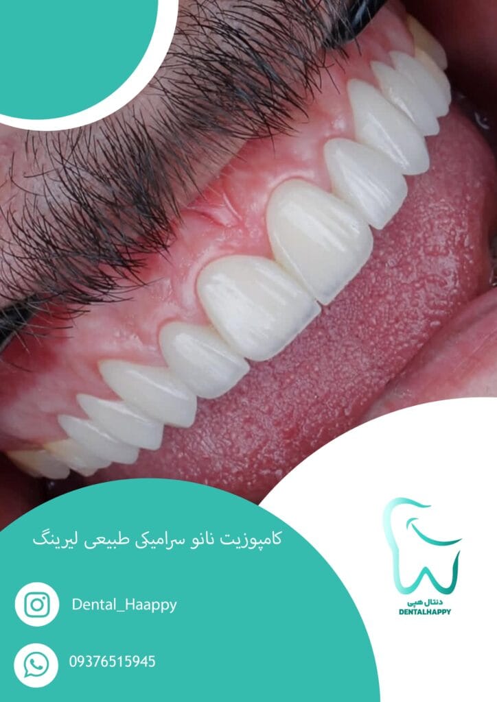 کامپوزیت نانو سرامیکی طبیعی لیرینگ - دنتال هپی