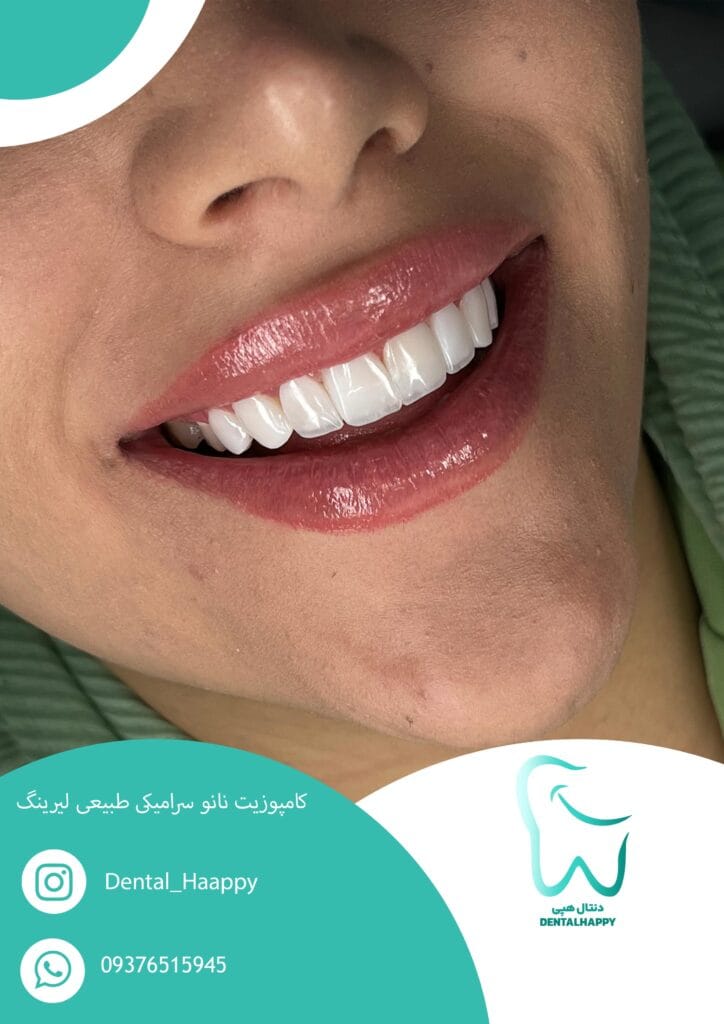 کامپوزیت نانو سرامیکی طبیعی لیرینگ - دنتال هپی