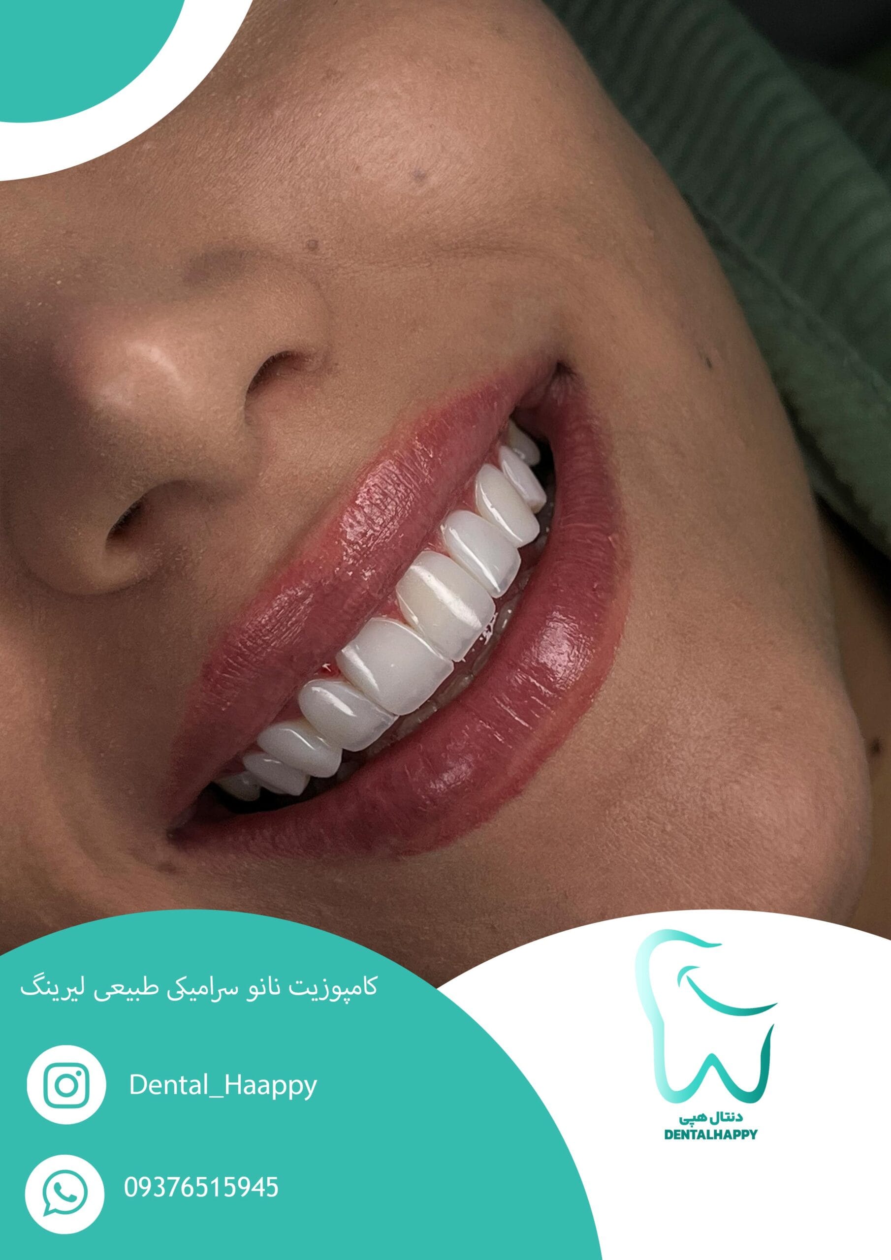 کامپوزیت نانو سرامیکی طبیعی لیرینگ - دنتال هپی
