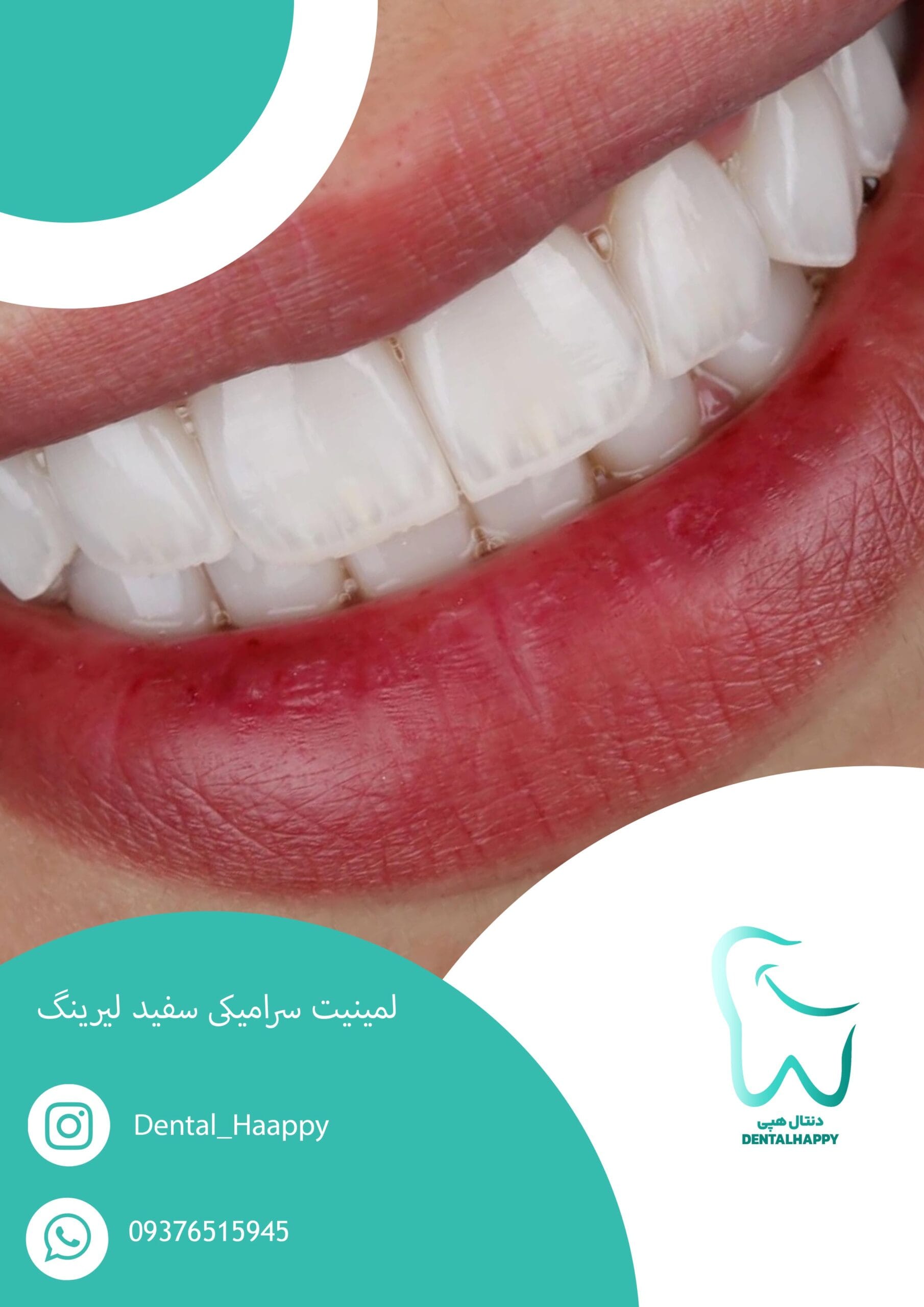 لمینیت سفید سرامیکی لیرینگ - دنتال هپی
