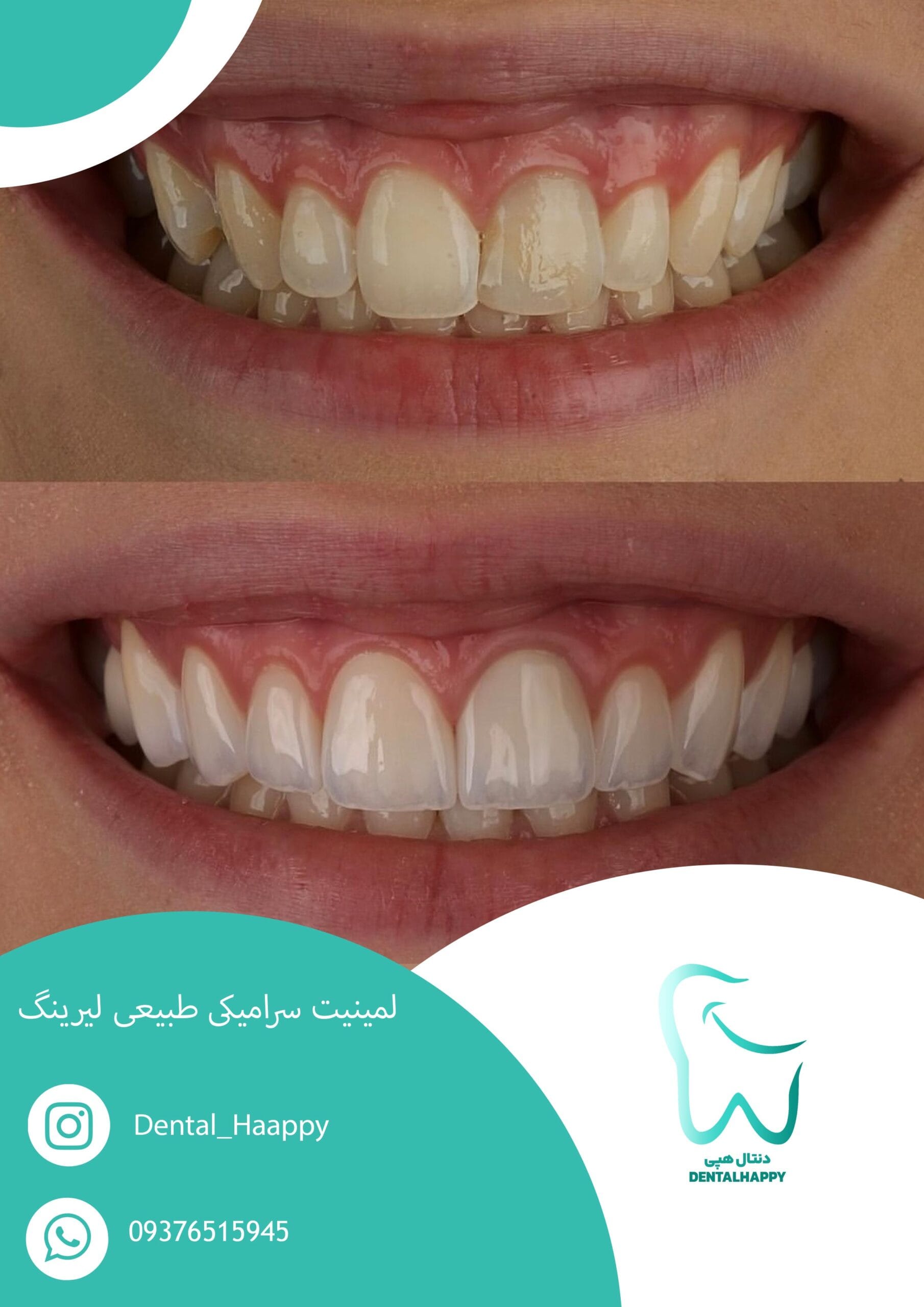 لمینیت سرامیکی طبیعی لیرینگ - دنتال هپی
