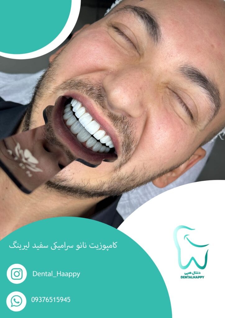 کامپوزیت نانو سرامیکی سفید لیرینگ - دنتال هپی