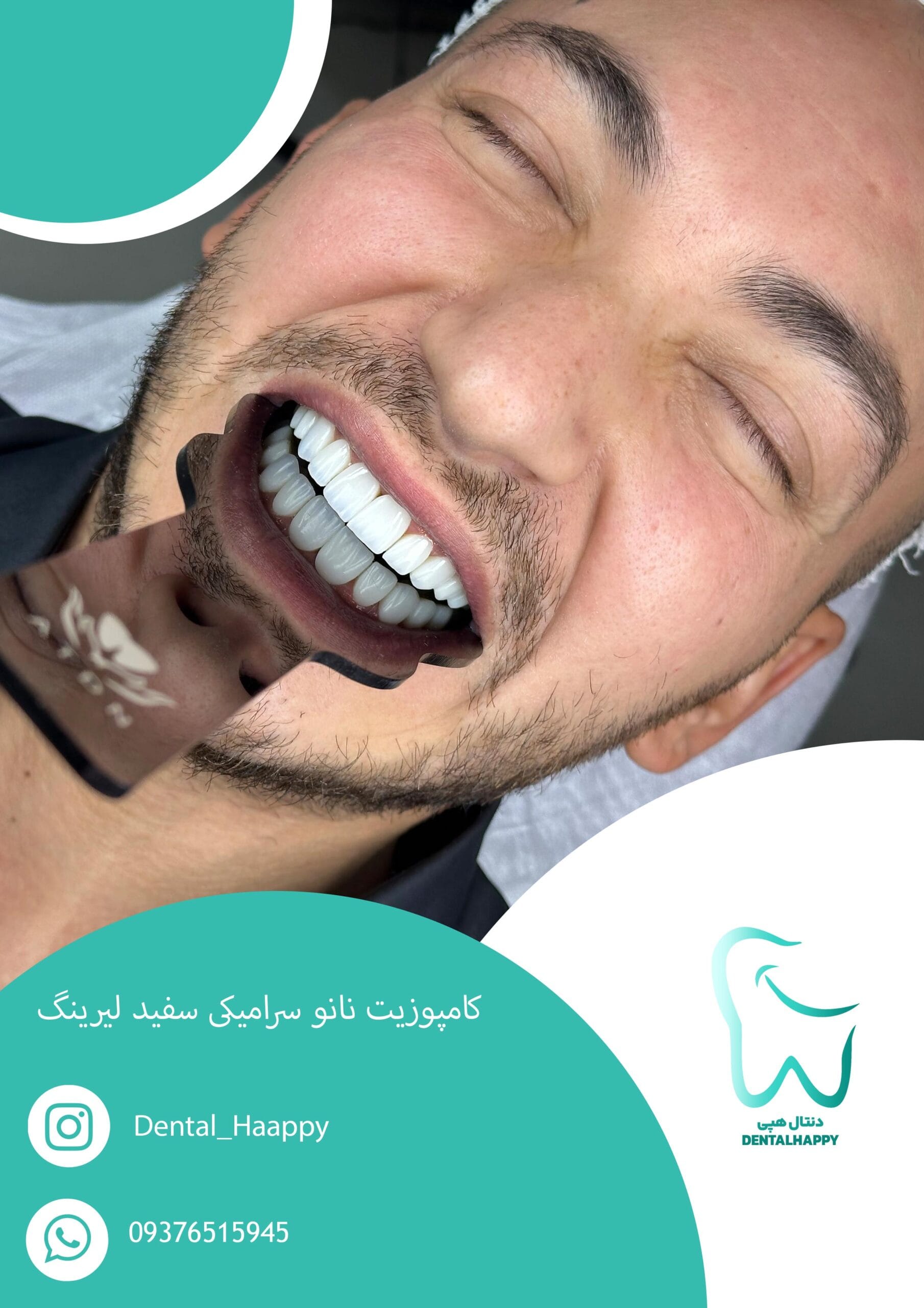 کامپوزیت نانو سرامیکی سفید لیرینگ - دنتال هپی