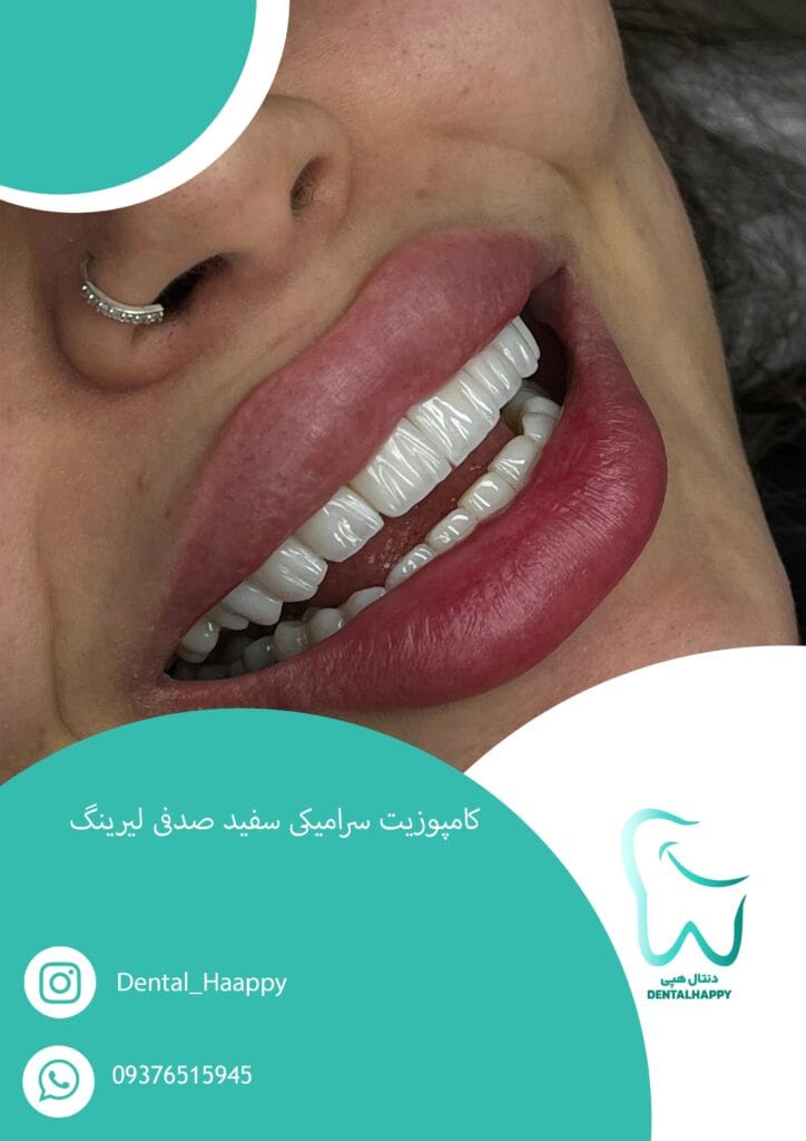 کامپوزیت سرامیکی سفید صدفی لیرینگ - دنتال هپی