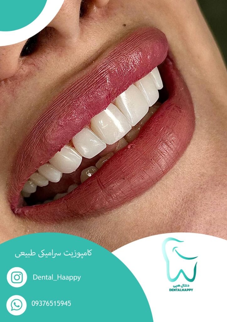 کامپوزیت سرامیکی طبیعی - دنتال هپی