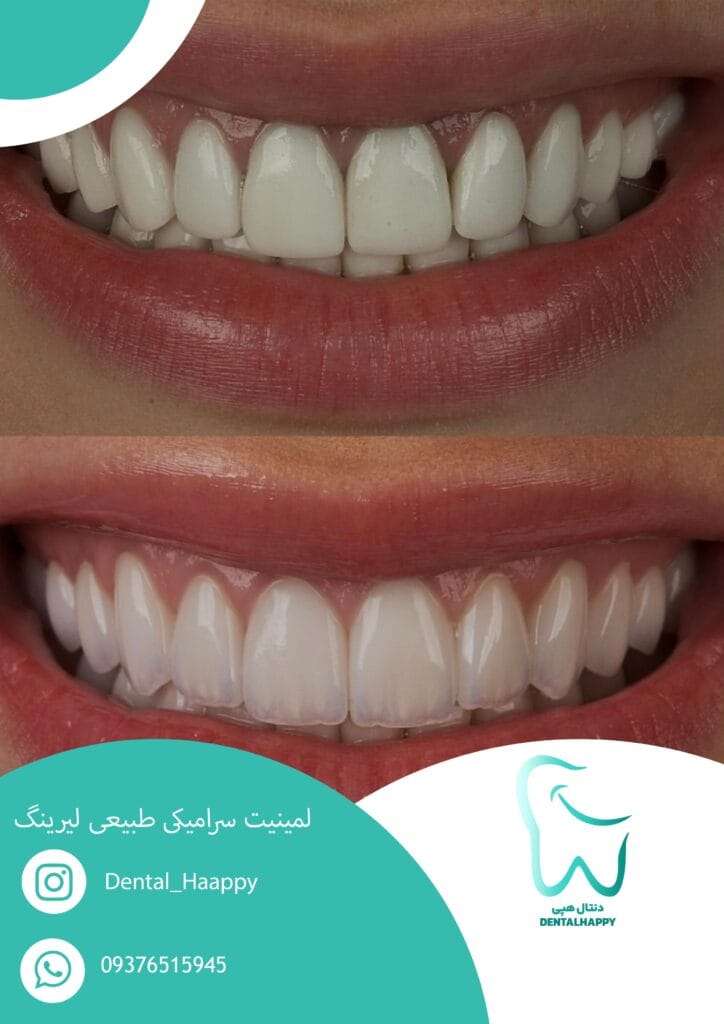 لمینیت سرامیکی طبیعی لیرینگ - دنتال هپی