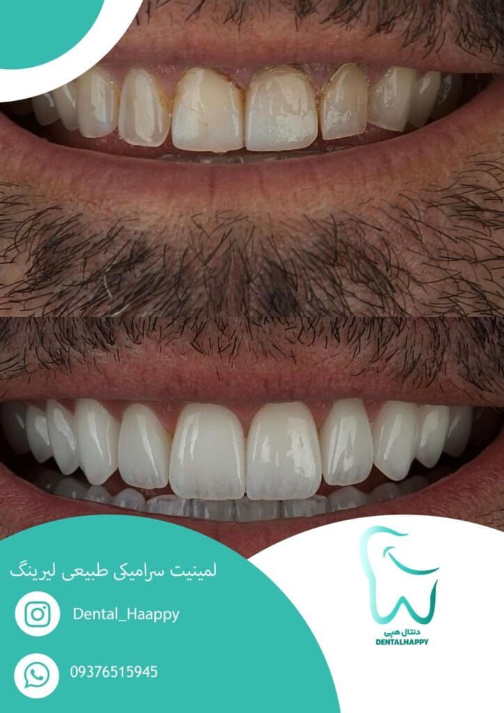 لمینیت سرامیکی طبیعی لیرینگ - دنتال هپی