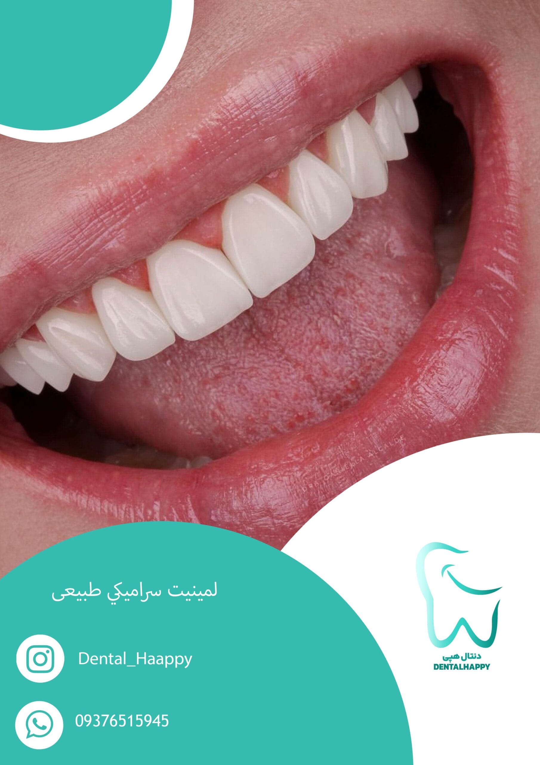 لمینیت سرامیکی طبیعی - دنتال هپی