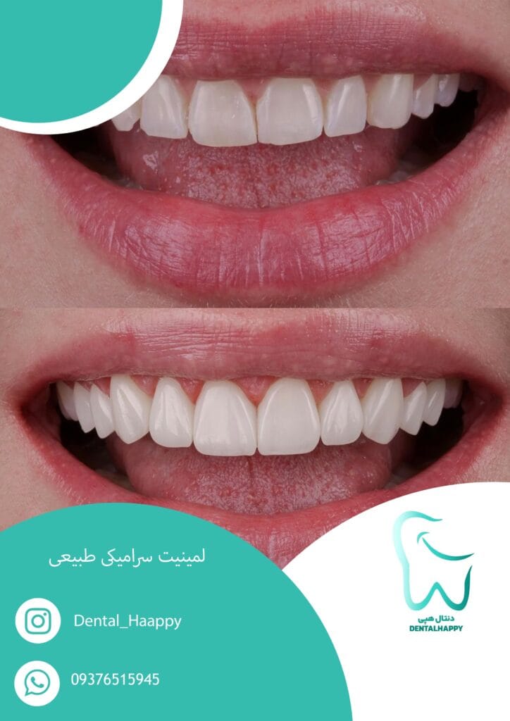 لمینیت سرامیکی طبیعی - دنتال هپی