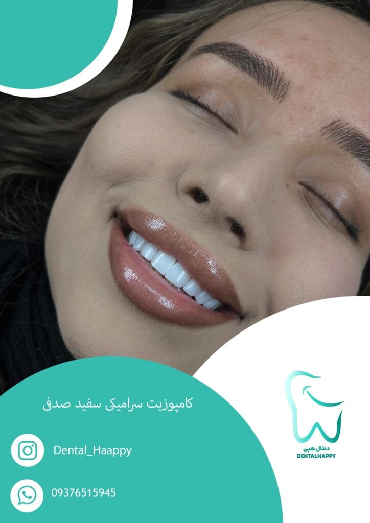 کامپوزیت سرامیکی سفید صدفی - دنتال هپی