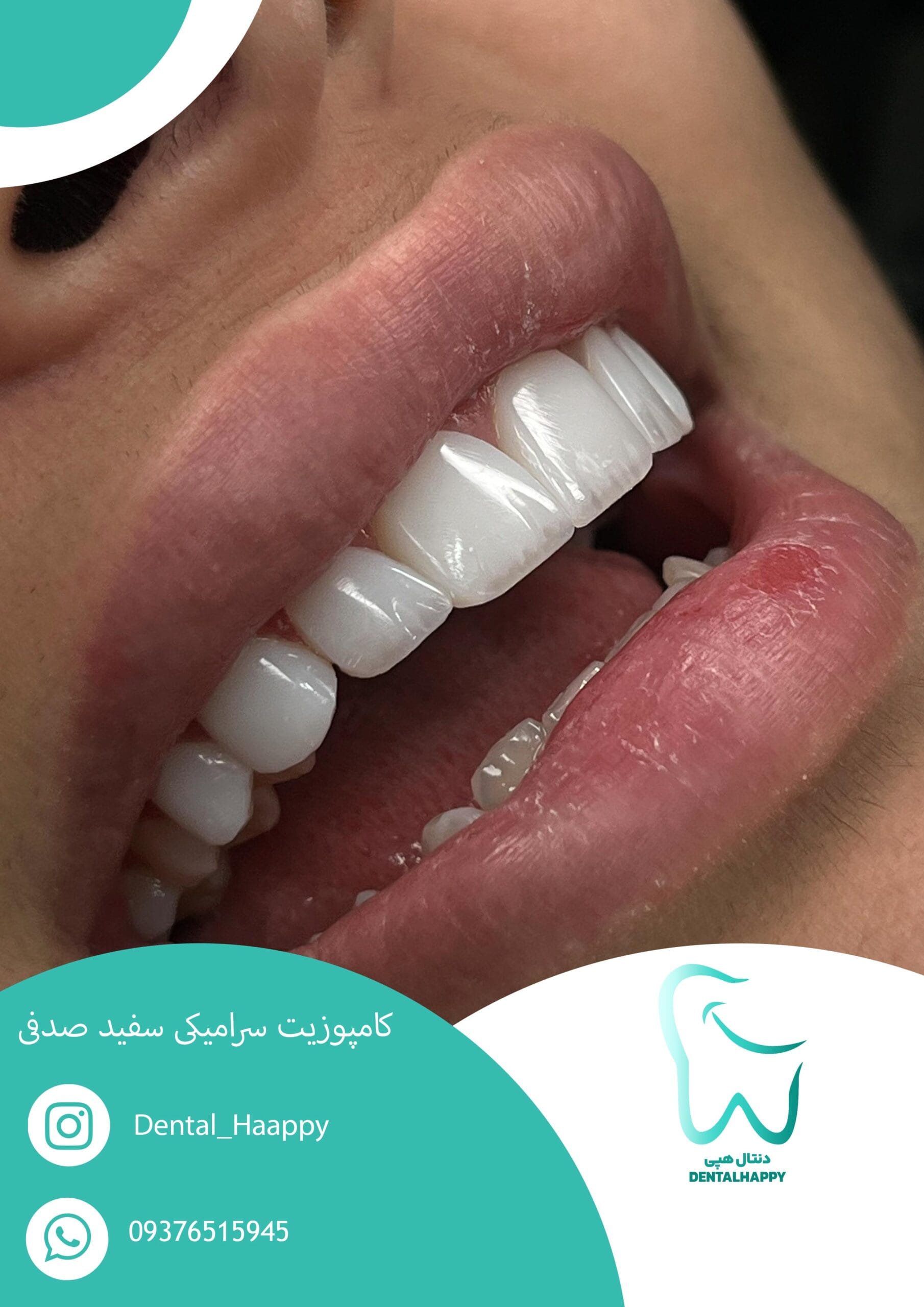 کامپوزیت سرامیکی سفید صدفی - دنتال هپی
