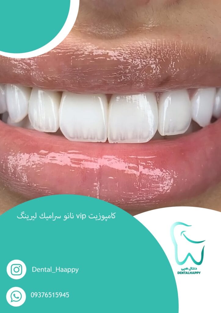 کامپوزیت vip نانو سرامیک لیرینگ - دنتال هپی