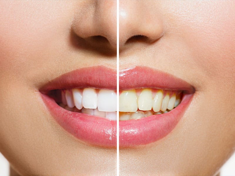فرق بین بلیچینگ دندان در مطب و در خانه چیست؟