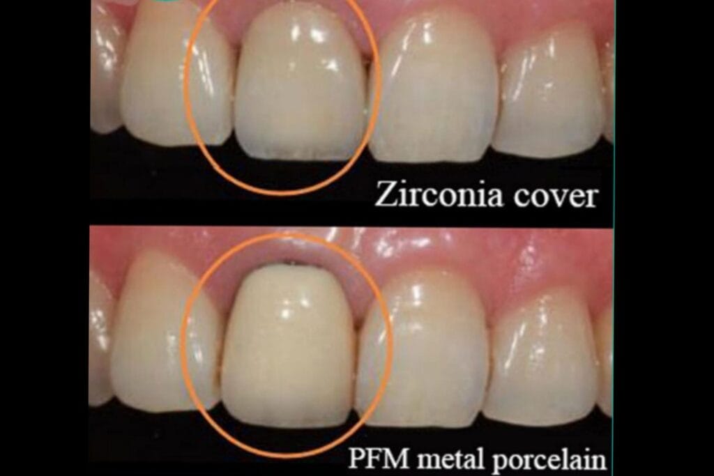 روکش دندان زیرکونیا و pfm