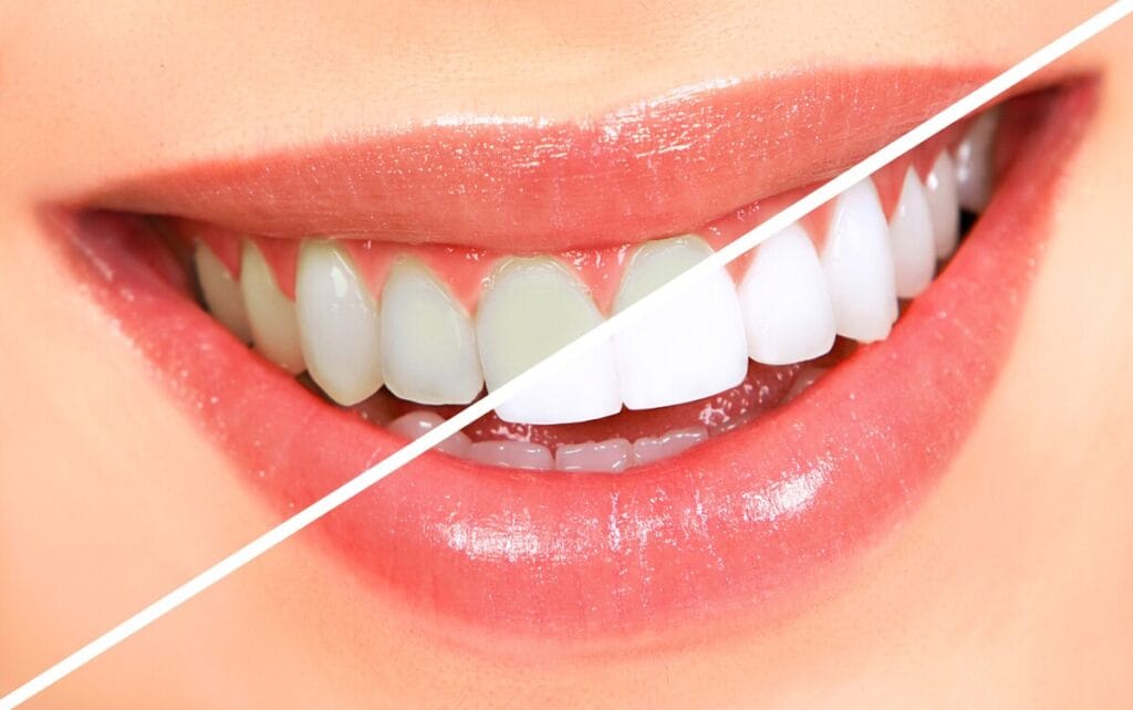 مقایسه بلیچینگ در مطب و بلیچینگ در خانه