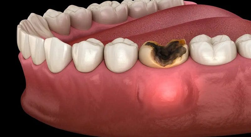 چه زمانی به دندانپزشک مراجعه کنیم؟