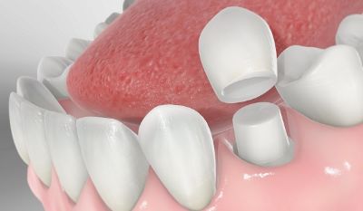 تفاوت بین روکش دندان موقت و دائمی