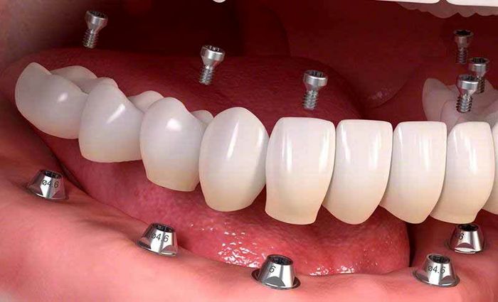 تکنولوژی‌های جدید در ایمپلنت دندان